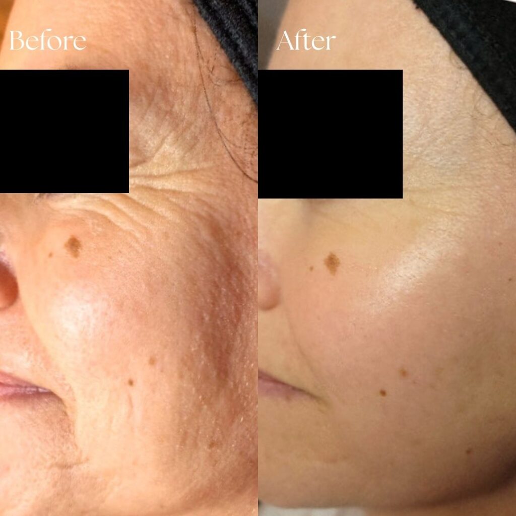 Sparkle Lifestyle & MediSpa — Moncton & Dieppe, NB 10 Before & After Skincare